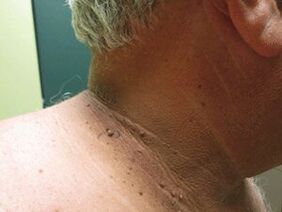 Die Gründe für das Auftreten von Pluralpapillomen am Körper