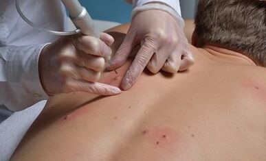 Möglichkeiten zur Entfernung von Papillomen