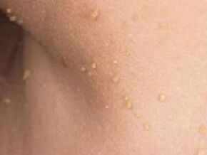 Gründe für das Auftreten von Papillomen am Körper