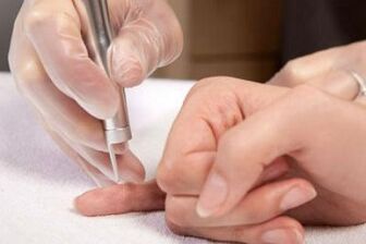 wie man Papillome am Körper loswird