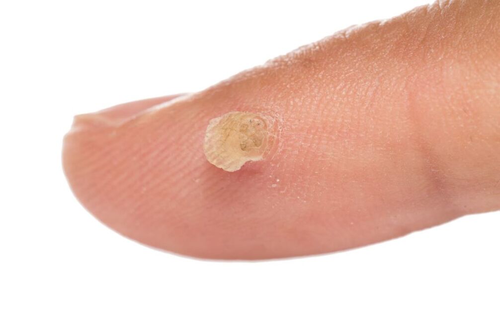 Genitalwarze am Finger