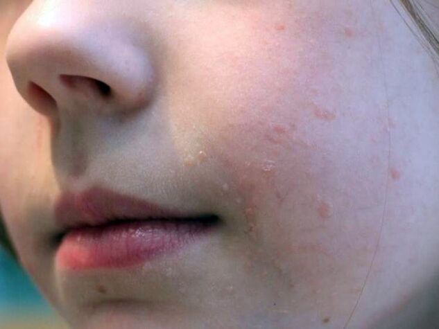Flache Warzen im Gesicht treten am häufigsten im Jugendalter auf